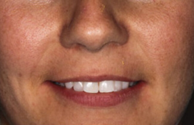 Before (Teeth)