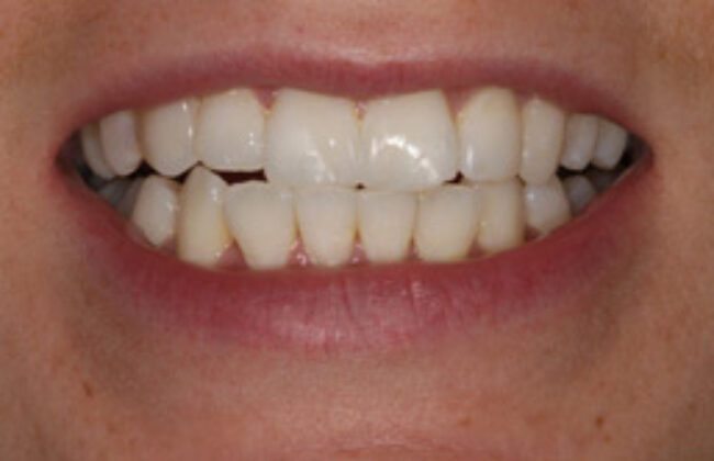After (Teeth)