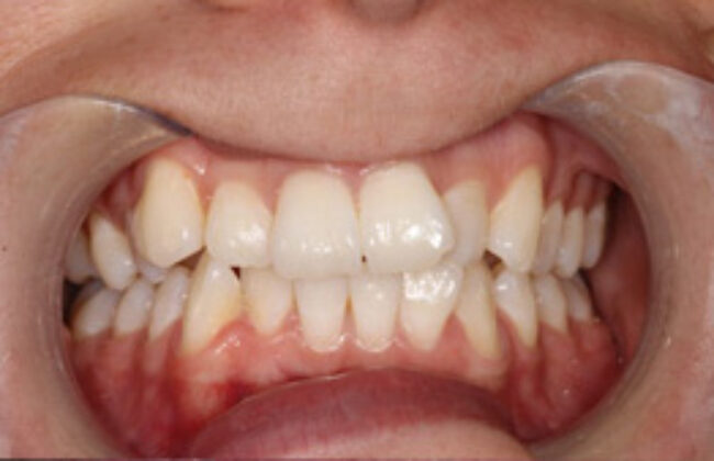 Before (Teeth)