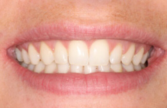 After (Teeth)