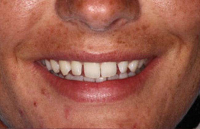 Before (Teeth)