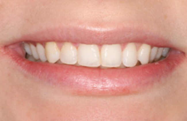 After (Teeth)