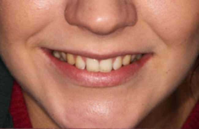 Before (Teeth)