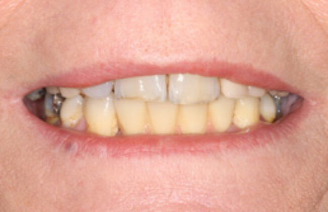 After (Teeth)