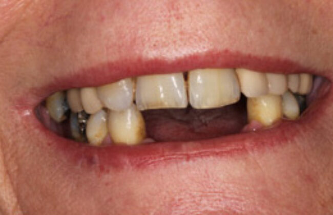 Before (Teeth)