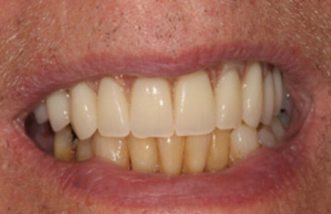 After (Teeth)
