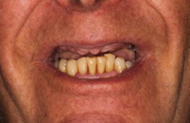 Before (Teeth)
