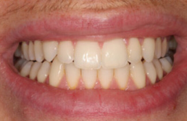 After (Teeth)