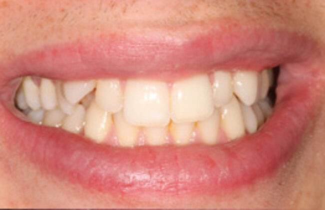 Before (Teeth)