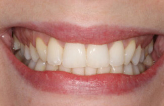 After (Teeth)