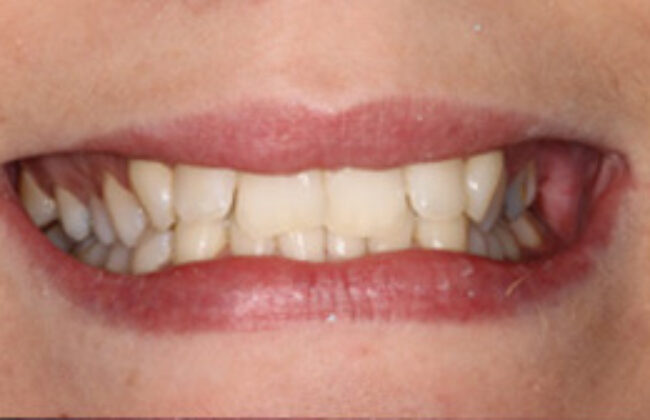 Before (Teeth)