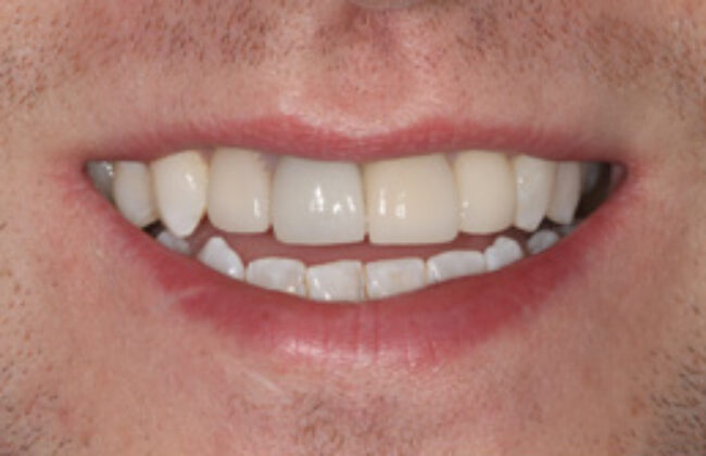 After (Teeth)