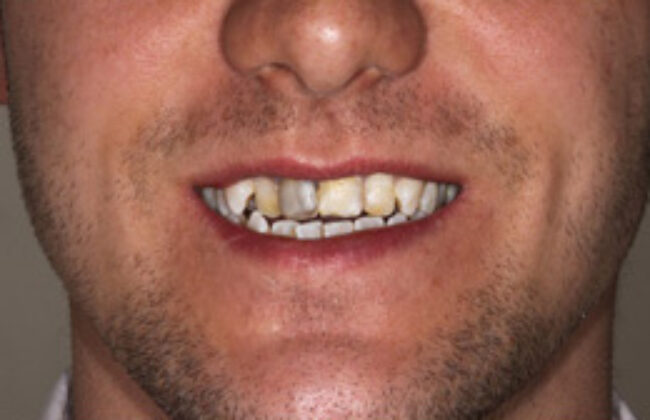 Before (Teeth)