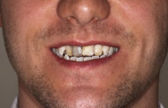 Before (Teeth)