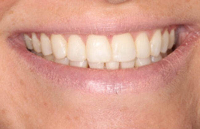 After (Teeth)