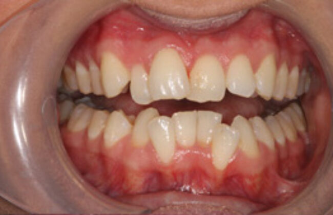 Before (Teeth)