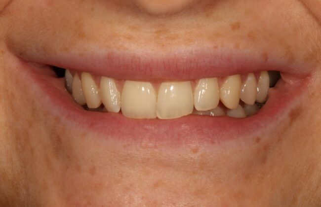 Before (Teeth)