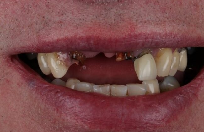 Before (Teeth)