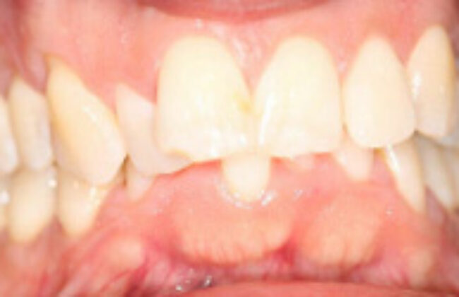 Before (Teeth)
