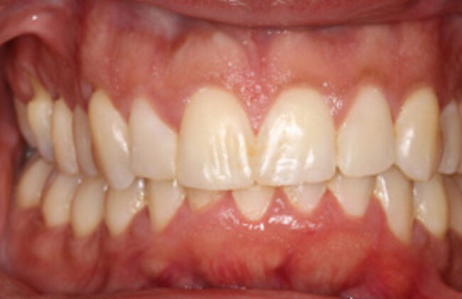 After (Teeth)