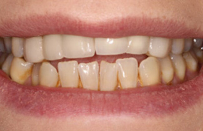 Before (Teeth)