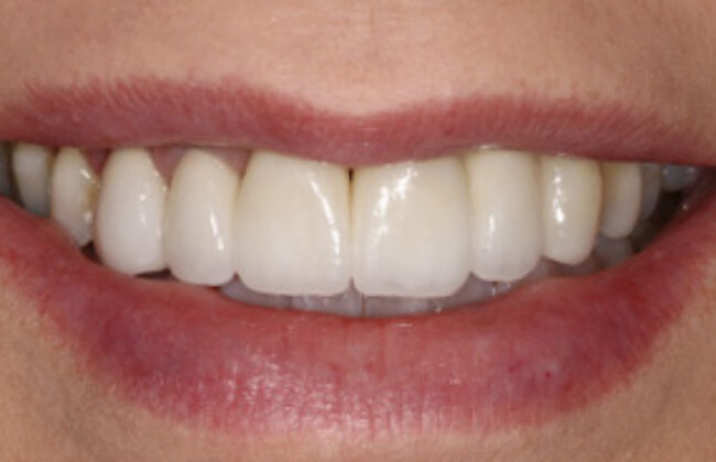 After (Teeth)
