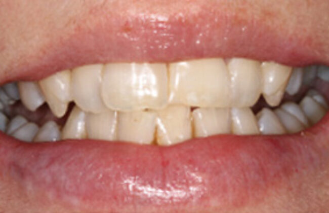 Before (Teeth)