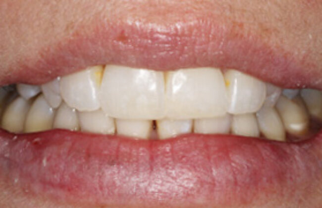 After (Teeth)