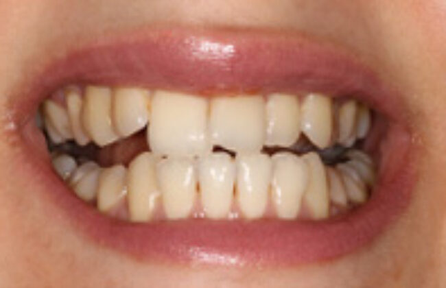 Before (Teeth)