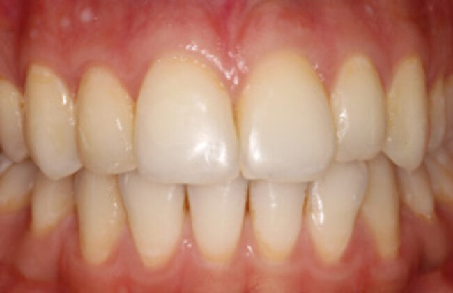 After (Teeth)