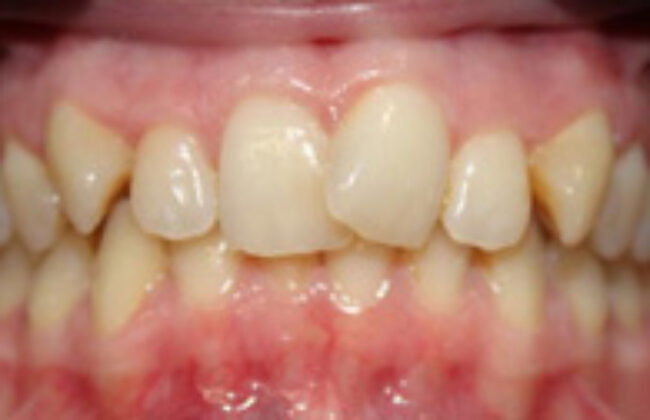 Before (Teeth)