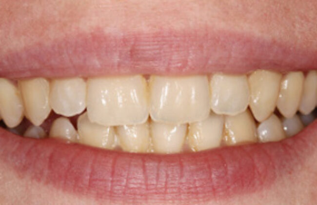 After (Teeth)