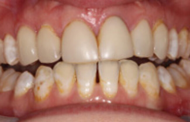 Before (Teeth)