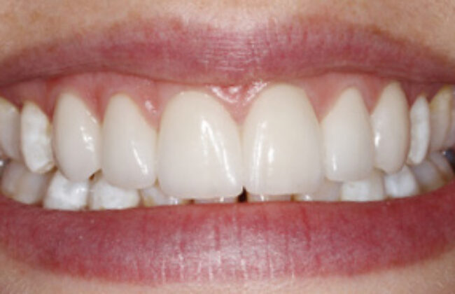 After (Teeth)