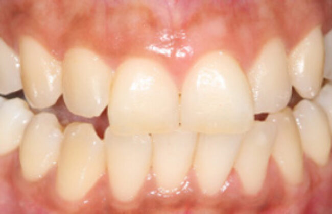 Before (Teeth)