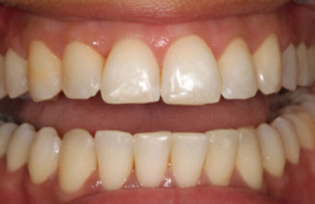 After (Teeth)