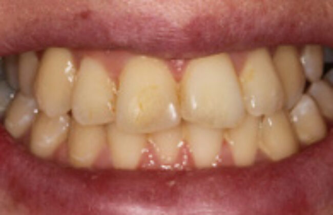 Before (Teeth)