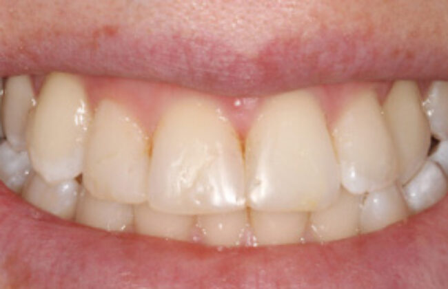 After (Teeth)