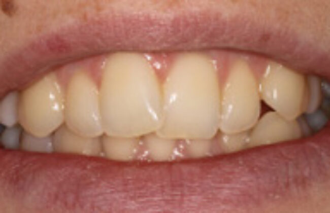 Before (Teeth)