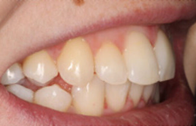 After (Teeth)