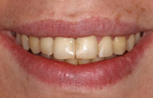After (Teeth)