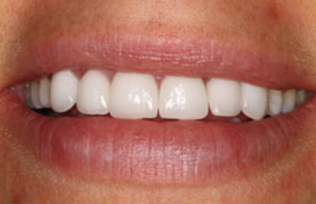 After (Teeth)