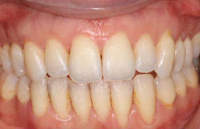 After (Teeth)