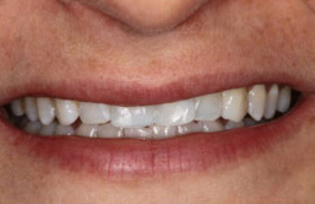 After (Teeth)