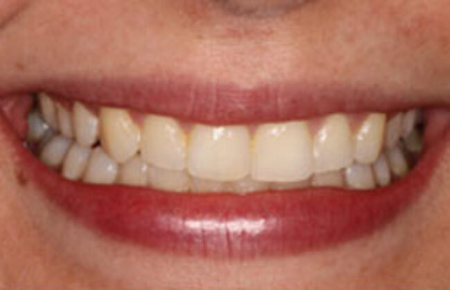 After (Teeth)