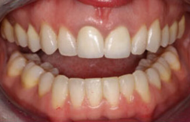 After (Teeth)