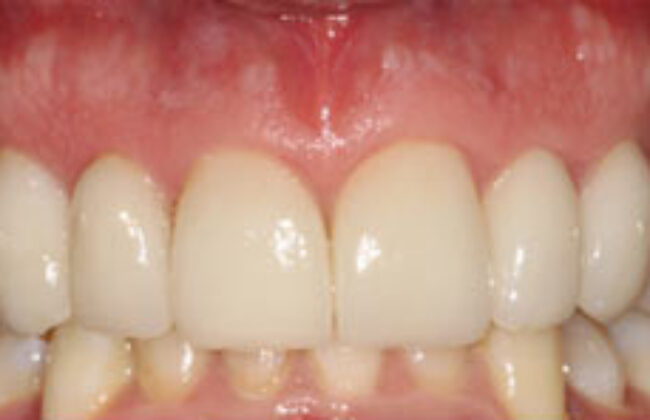 After (Teeth)
