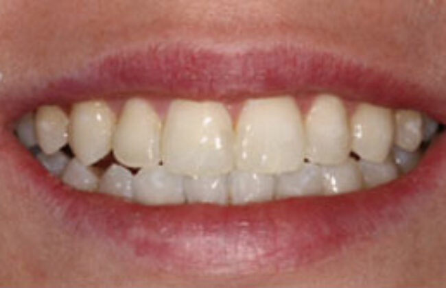 After (Teeth)
