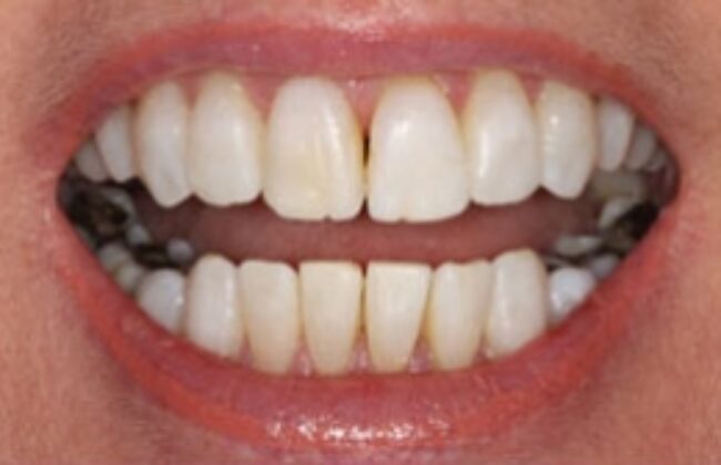 After (Teeth)