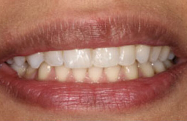 After (Teeth)